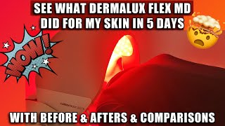 SEE WHAT DERMALUX FLEX MD DID FOR MY SKIN IN 5 DAYS  W BEFORE amp AFTERS DEMO amp COMPARISONS [upl. by Nodnyl362]