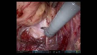 daVinci distal rectal cancer surgery with original audio [upl. by Miza245]