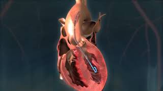 Impella CP® Heart Pump Animation [upl. by Furiya]