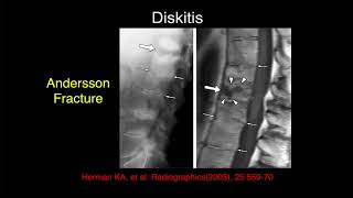 MRI of the Lumbar Spine  Part 7  Lumbar Inflammation [upl. by Ydnec]