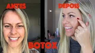 BOTOX  Antes e depois  Quanto Custa  Dói [upl. by Filberte]