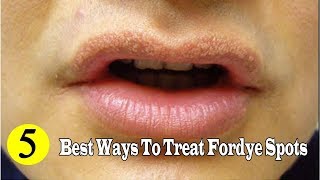 5 Best Ways to Remove Fordyce Spots Naturally at Home YouTube [upl. by Cinimmod]