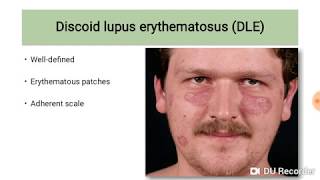 Discoid Lupus Erythematosus DLE [upl. by Iormina970]