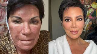 Celebrities Real Faces Exposed After Botched Plastic Surgery [upl. by Banerjee]