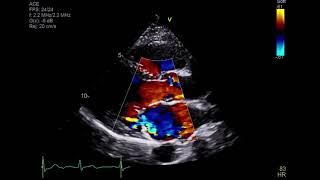 Video 1 Parasternal long axis view with color doppler [upl. by Hamimej]