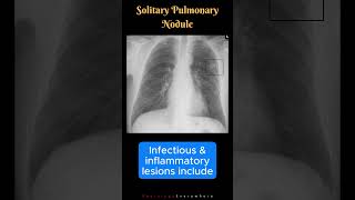 Solitary Pulmonary Nodules Mass like Lesions Differential Diagnosis shorts [upl. by Brause718]