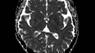 Choroid Plexus Xanthogranuloma [upl. by Akinnor]