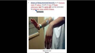 Radial Nerve part 2  Dr Ahmed Farid [upl. by Essy]