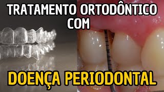 Tratamento ortodôntico de pacientes com doença periodontal  Parte 1 Aula 235 [upl. by Nyluqcaj63]