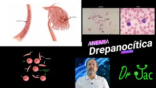 Anemia falciforme o Drepanocítica [upl. by Aramac321]