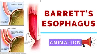 Barretts Esophagus  Pathology Dysplasia and Carcinoma [upl. by Delamare]