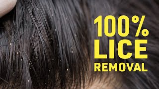 Get Rid Of Lice COMPLETELY  Safe amp Natural Home Remedies For Lice amp Nits [upl. by Natlus]