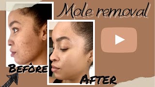 Mole Removal Vlog start to finish What to expect DPN removal BeforeampAfter care tips [upl. by Einapets593]