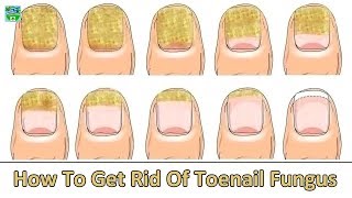 How to Get Rid of Toenail Fungus Fast and Naturally  Home Remedies [upl. by Thoer]