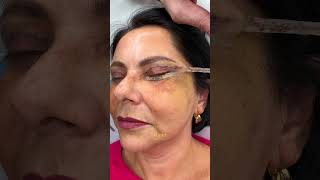 Video Before amp After 7 zile după BLEFAROPLASTIE totală la Clinica Dr Levy Like amp Subscribe [upl. by Nyved786]