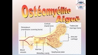 Ostéomyélite aiguë hematogene [upl. by Higgins]