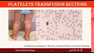 Lecture 218 Platelets Transfusion Reactions [upl. by Aniroc]