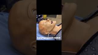 Laryngospasm notch  Larsons point  Stridor ✓ Jaw thrust maneuver ✓ shortvideo [upl. by Hallam363]