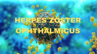 Herpes zoster ophthalmicus  OPHTHALMOLOGY  NEETPG  virus  keratitis [upl. by Assed]