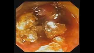 Direct Peroral Cholangioscopy with Electrohydraulic Lithotripsy for Cystic Duct Stone [upl. by Willie71]