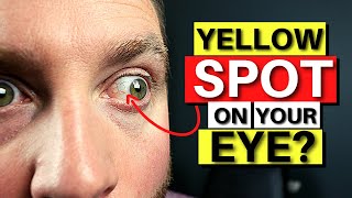 Yellow SPOT On Your Eye  Pinguecula Explained [upl. by Ettenil627]