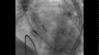 Edwards SAPIEN Transcatheter Heart Valve Deployment  TAVR [upl. by Seward]