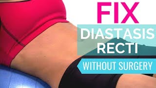 How To Fix Diastasis Recti  Heal Diastasis Recti Naturally Without Surgery [upl. by Hepsoj20]