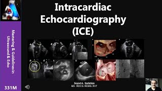 Echocardiography Essentials Assessing left ventricular global systolic function LVF [upl. by Adnilrev]