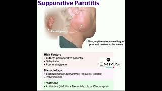 💠 Supurrative parotitis 💠 [upl. by Gingras]