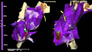 AV node reentry tachycardia atrial activation with 3D mapping [upl. by Assirrac978]