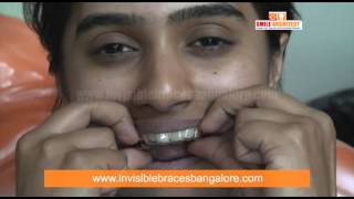 Clear Path Invisble Braces Patient Review in Bangalore  Clear Aligner Braces in Karnataka India [upl. by Chimene]