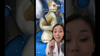 Drilling a cavity that’s blue inside dentist drilling cavities dentalvideo [upl. by Alliehs]