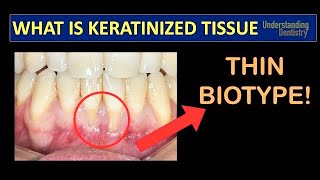 Gingival Recession Treatment How to Check the Keratinized Gingival Tissue Periodontal Maintenance [upl. by Ymia]