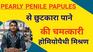 Homoeopathy medicine for pearly penile papules। [upl. by Nats]