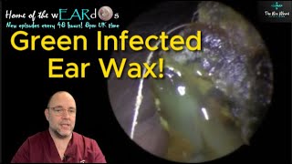 GREEN INFECTED EAR WAX 249 ear earwax earwaxremoval earcleaning asmr fyp foryou satisfying [upl. by Ayifa]