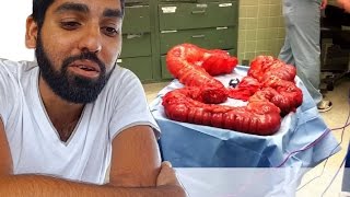 The Only Way to Cure Ulcerative Colitis is to Remove Your Colon [upl. by Mad]