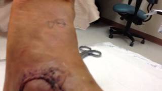 5 Days After An Ankle Surgery [upl. by Barra]