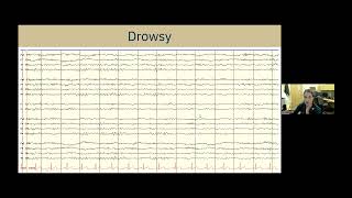 Understanding EEG A Practical Guide for Patients and Families [upl. by Iruy]