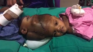 Indian doctors separate twins joined at the head [upl. by Yortal]