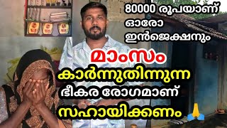 ശരീരം കുഴിഞ്ഞു പോകുന്ന അസുഖം 🙏🙏 എല്ലാരും സഹായിക്കണം 🙏 [upl. by Feola614]