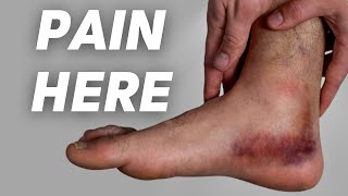 Deltoid Ligament Sprain EXERCISES Causes Symptoms Diagnosis and Treatment [upl. by Nnyleuqaj]