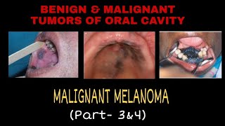 PART 3 amp PART 4  MALIGNANT MELANOMA [upl. by Annekim237]