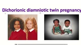 Anatomy of dichorionic and diamniotic twin pregnancy with sonographic feature twin obimagesnet [upl. by Sandra]