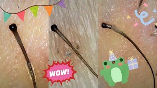 Satisfying Hair Follicle Plucks Big Roots Hair Extraction Under Microscope [upl. by Nylyaj407]