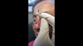 Cleaning Facial Stiches [upl. by Boardman]