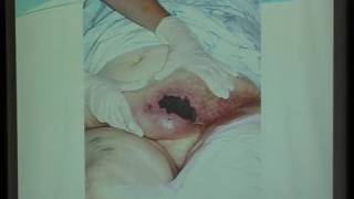 UNC VIDEOS calcified Uremic Arteriolopathy Calciphylaxis Dr Mohamed Sobh [upl. by Enihpesoj930]