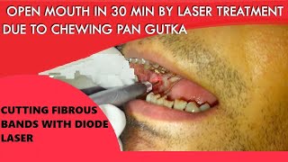 Laser Cutting of Fibrous Band of OSMF Patient ORAL SUBMUCOUS FIBROSIS TREATMENT [upl. by Gonick]