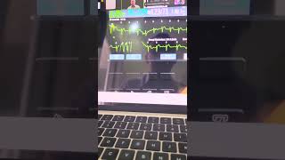 Cardioversi VT ventricular tachycardia monomorpic ke SR sinus rhythm gakur viralvideo cardio [upl. by Ahsemrac]