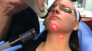 Recovery After CO2 Laser Facial [upl. by Wachtel]