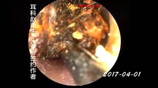 Earwax Removal Extractions More Than 50 Years Old Earwax 50年窖藏 外耳道挖耳屎清理 耳垢 耳垢 [upl. by Afirahs756]